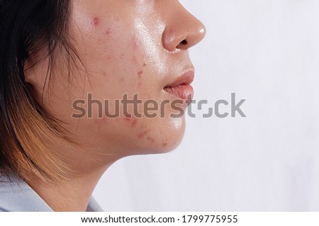 Close up Acne skin caused by Hormone,Oily face in woman face. Right side