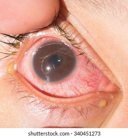 anterior uveitis