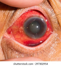 Close Up Of The Acute Glaucoma During Eye Examination.