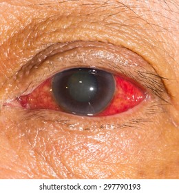 Close Up Of The Acute Glaucoma During Eye Examination.