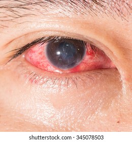 Close Up Of Acute Viral Conjunctivitis During Eye Examination.