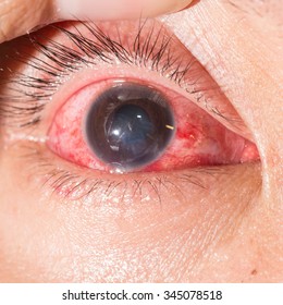 Close Up Of Acute Viral Conjunctivitis During Eye Examination.