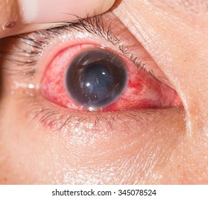 Close Up Of Acute Viral Conjunctivitis During Eye Examination.