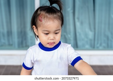 Close Up Of Adorable Little Child Girl With Large Capillary Strawberry Hemangiomas Red Birthmark On Head. Happy Asian Girl, A Positive Female Kid, Looking At Mother Or Someone. Health Care Concept