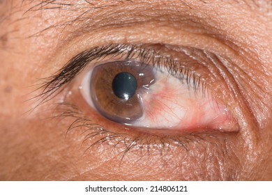 Close Advance Pterygium During Eye Examination Stock Photo 214806121 ...