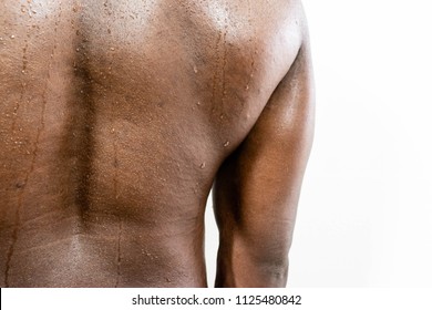 stretch marks on back
