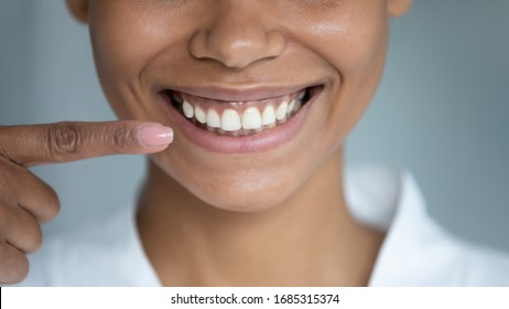 Close up african woman point finger at perfect straight hollywood white toothy smile. After whitening dental treatment procedure showing result, health stomatology dentistry service, oralcare concept