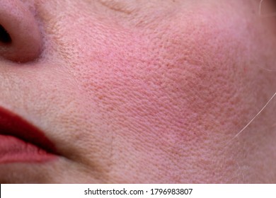 close up of ageing and flushed problem skin of mature woman 