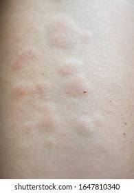 Nettle Rash Images, Stock Photos & Vectors | Shutterstock