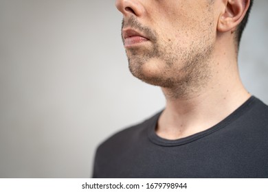 Close Up Of Alopecia Areata On Beard