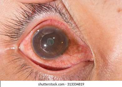 anterior uveitis