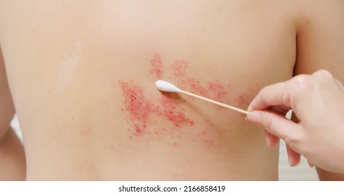 Close Up Of Apply Ointment With Shingles Disease On Skin