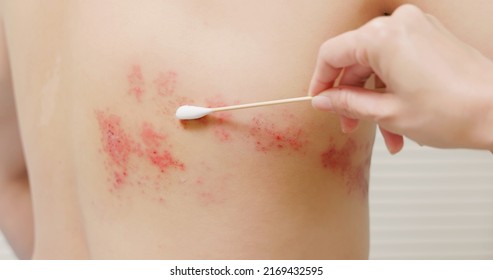 close up of apply ointment with shingles disease on skin - Shutterstock ID 2169432595