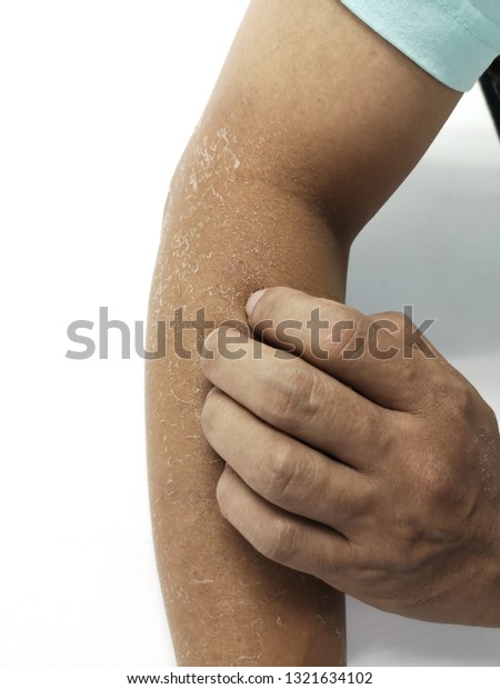 Close Arm Skin Peeling Off Due Stock Photo Edit Now