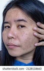 Close up of Asian adult woman face has freckles, large pores, blackhead pimple and scars problem from not take care for a long time. Soft focus of skin problem face. Treatment and Skincare concept - Shutterstock ID 2128118663
