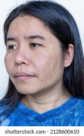 Close up of Asian adult woman face has freckles, large pores, blackhead pimple and scars problem from not take care for a long time. Soft focus of skin problem face. Treatment and Skincare concept - Shutterstock ID 2128600610