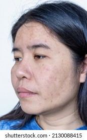 Close up of Asian adult woman face has freckles, large pores, blackhead pimple and scars problem from not take care for a long time. Soft focus of skin problem face. Treatment and Skincare concept - Shutterstock ID 2130088415