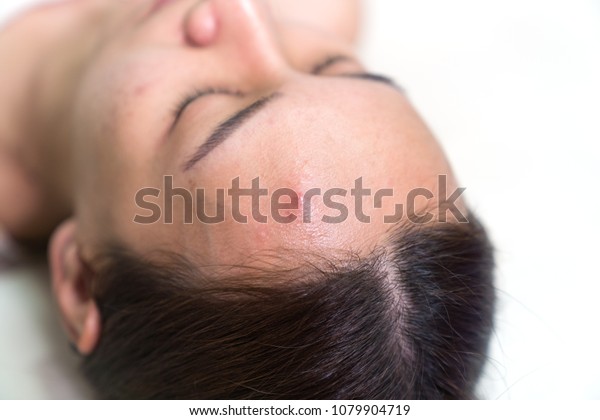 Close Asian Beautiful Woman Acne Skin Stock Photo (Edit Now 