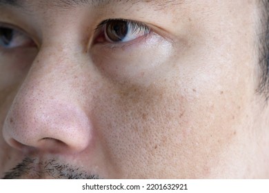 Close Up Asian Man Face With Freckles Dark Spots From Uv Light , Skin Care And Health Problem Concept