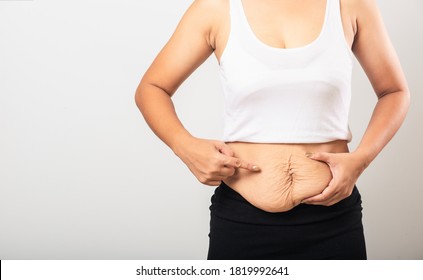 Close up of Asian mother woman pointing stretch mark loose lower abdomen skin she fat after pregnancy baby birth, studio isolated on white background, Healthy belly overweight excess body concept