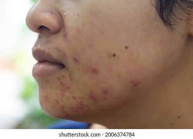 Close Up Asian Woman With Acne On The Face Caused By Wear A Face Mask During The Outbreak Of Covid-19 Coronavirus.