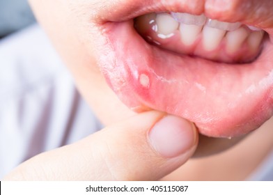 Close up of Asian woman with aphtha on lip - Shutterstock ID 405115087