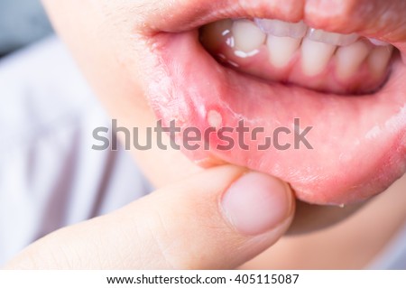 Close up of Asian woman with aphtha on lip