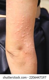 Close Up Asian Woman Right Arm Have Red Rash On Skin Background From Insect Bites Allergy 