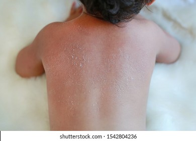 Close Up Baby Back Dry Skin. Baby Have Very Dry Peeling Skin.