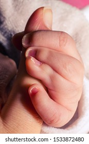 Close Up Of Baby Girl Hands, With Syndactyly. Medical Condition, Webbed Fingers