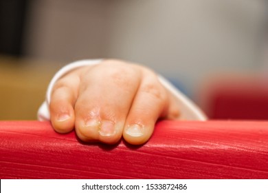 Close Up Of Baby Girl Hands, With Syndactyly. Medical Condition, Webbed Fingers