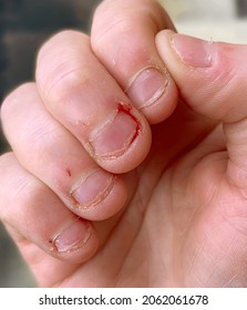 Close Up Of Badly Bitten Finger Nails