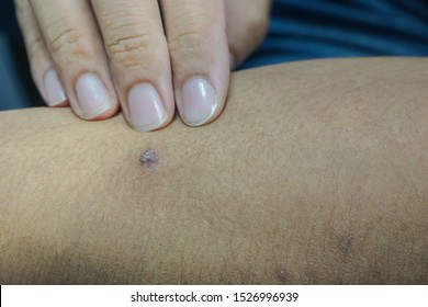 Close Up Big Pimple On Man Left Hand 