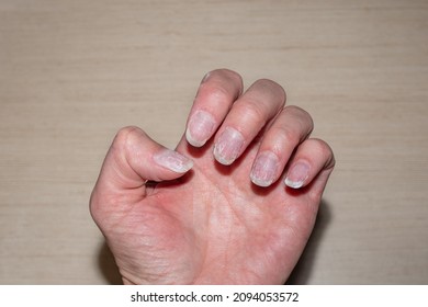 Close- Up Of Bitten And Brittle Nails Without Manicure. Overgrown Cuticle Fingernails And Tainted Nail Plate. Cuticle Overgrown Nails And Damaged Nail Plate. Concept Of Nail Care And Health.