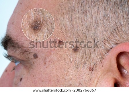 close up the black spot on human skin. Melanoma is a type of skin cancer develops on human skin from the pigment-producing cells melanocytes. Risk to be skin cancer.