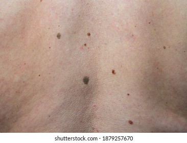 Close Up The Black Spot On Male Human Back Skin. Melanoma  Is A Type Of Skin Cancer Develops On Human Skin From The Pigment-producing Cells Melanocytes. Risk To Be Skin Cancer.