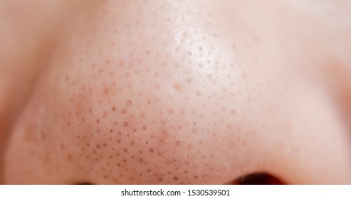 Close Up Of Blackheads On Asian Woman Nose