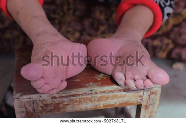 Close up\
of bound foot of a 97 years old Chinese old woman, born in 1919,\
the last generation that bind the feet of\
woman