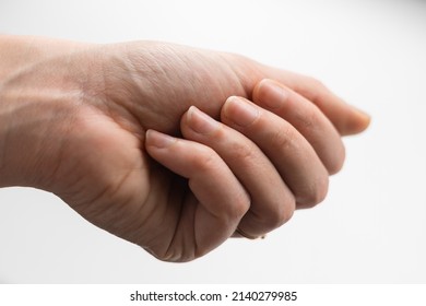 Close Up Of Brittle Nails On Woman Hand. White Background. Brocken And Dry Fingernail. Avitaminosis And Micro Elements Deficits 