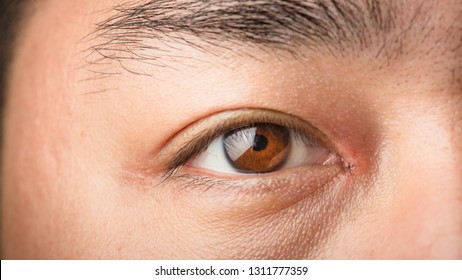 Close up of a brown eye which was operated and sutered at the cornor of the eye