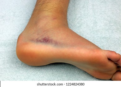 Bruised Ankle Images, Stock Photos & Vectors | Shutterstock