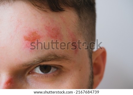 close up of brutal injured men’s face portrait, injury scratches after accident, infection medical protection