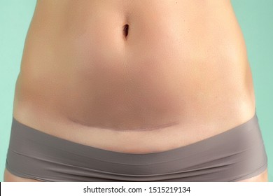 Close up of a caesarean section scar in a woman. Health and childbirth