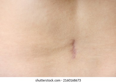 close up of careful scar after surgery on the body