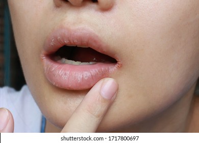 close up of chapped, cracked lips caused wound on the corner of the lips: dry skin problem with mouth disease, Angular cheilitis - Shutterstock ID 1717800697