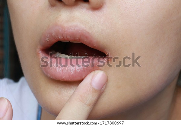 close up of chapped, cracked lips caused wound\
on the corner of the lips: dry skin problem with mouth disease,\
Angular cheilitis