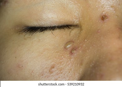 Types Of Herpes Viruses Images, Stock Photos & Vectors | Shutterstock