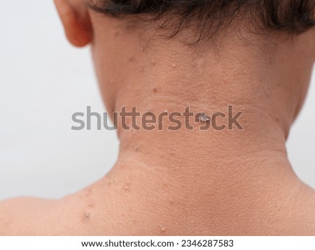 close up of child with smallpox on back of neck