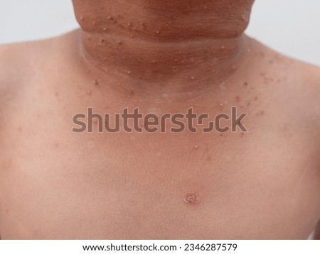 close up of child with smallpox under neck