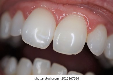 Close Up Of Clean White Front Incisor Teeth